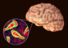 Brain-Eating Amoeba Strikes — Teen Dead Brain with zoomed-in view of amoeba infection.