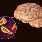 Brain-Eating Amoeba Strikes — Teen Dead Brain with zoomed-in view of amoeba infection.