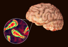 Brain-Eating Amoeba Strikes — Teen Dead Brain with zoomed-in view of amoeba infection.